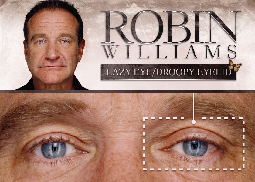 Project Monarch - Droopy Eyelid - Robin Williams
